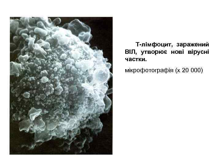  Т-лімфоцит, заражений ВІЛ, утворює нові вірусні частки. мікрофотографія (х 20 000) 