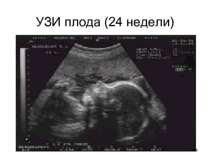 Плода нижний новгород. Снимки УЗИ 24 недели беременности. Профиль плода на УЗИ 20 недель.