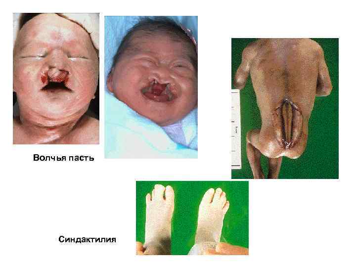 Волчья пасть Синдактилия 