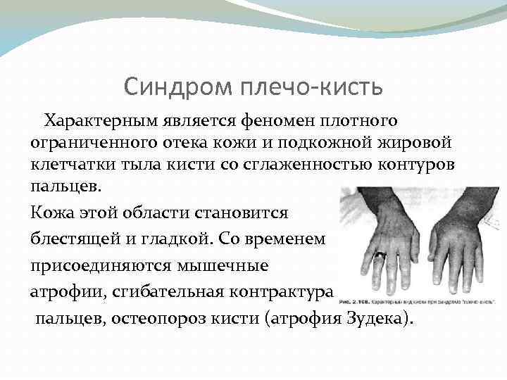 Синдром плечо-кисть Характерным является феномен плотного ограниченного отека кожи и подкожной жировой клетчатки тыла