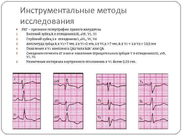 Гипертрофия правого желудочка на экг. Хроническое легочное сердце ЭКГ. Острое легочное сердце на ЭКГ. ЭКГ при хроническом легочном сердце. ЭКГ признаки ХЛС.