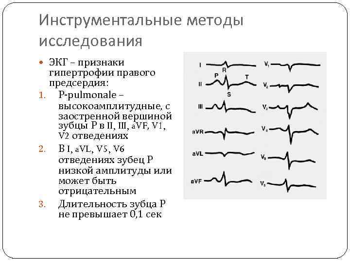 Инструментальные методы исследования ЭКГ – признаки гипертрофии правого предсердия: 1. P-pulmonale – высокоамплитудные, с