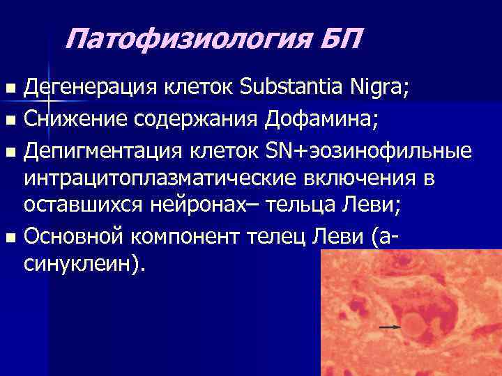 Патофизиология БП Дегенерация клеток Substantia Nigra; n Снижение содержания Дофамина; n Депигментация клеток SN+эозинофильные