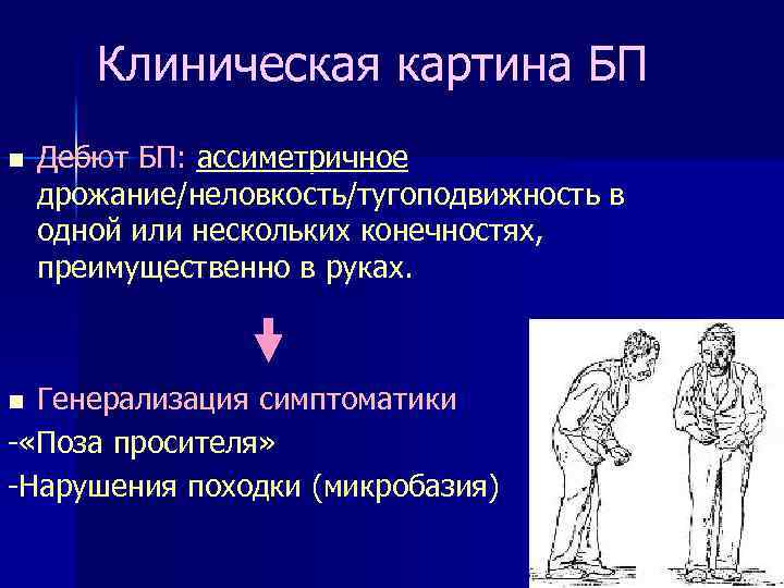 Клиническая картина БП n Дебют БП: ассиметричное дрожание/неловкость/тугоподвижность в одной или нескольких конечностях, преимущественно