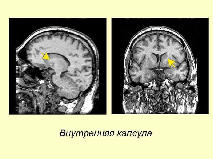 Внутренняя капсула 