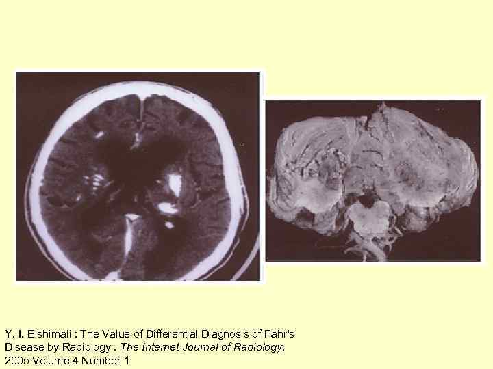 Y. I. Elshimali : The Value of Differential Diagnosis of Fahr's Disease by Radiology.