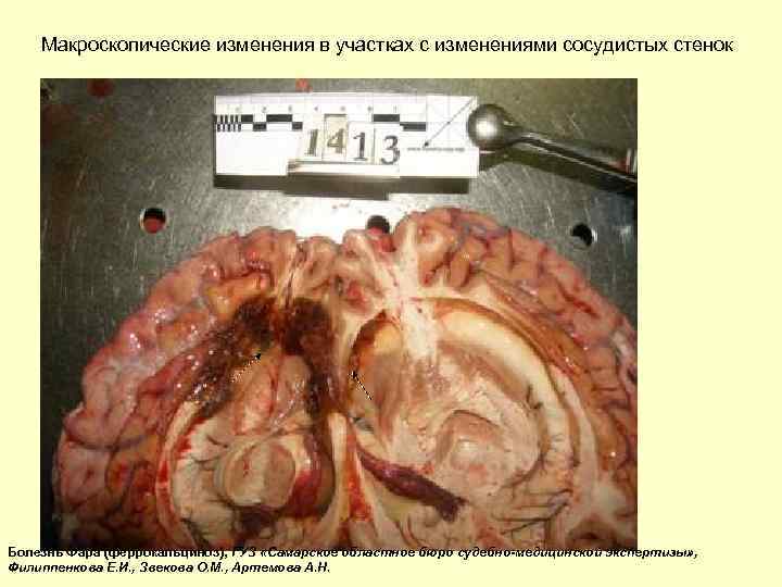 Макроскопические изменения в участках с изменениями сосудистых стенок Болезнь Фара (феррокальциноз), ГУЗ «Самарское областное