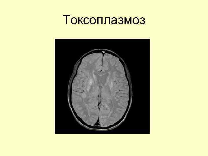 Токсоплазмоз 