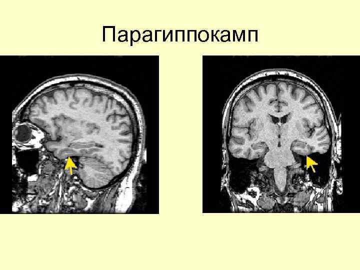 Парагиппокамп 