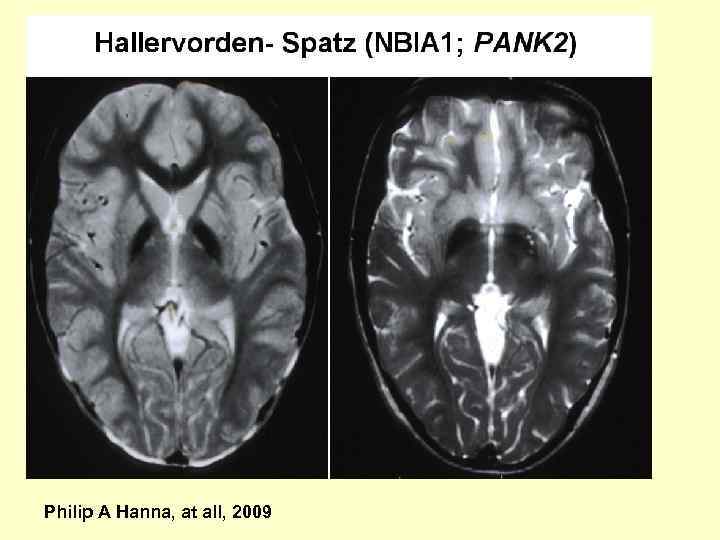 Philip A Hanna, at all, 2009 