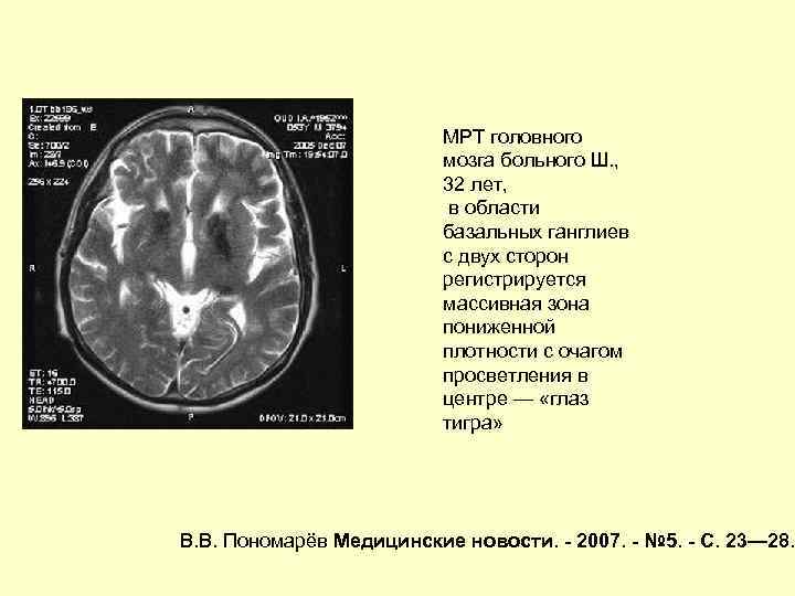 Что значит очаг в головном мозге. Анатомия базальных ганглиев кт. Плотность тканей головного мозга на кт. Очаг повышенной плотности в головном мозге кт. Дегенерация головного мозга мрт.