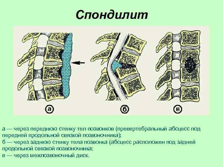 Спондилит а — через переднюю стенку тел позвонков (превертебральный абсцесс под передней продольной связкой