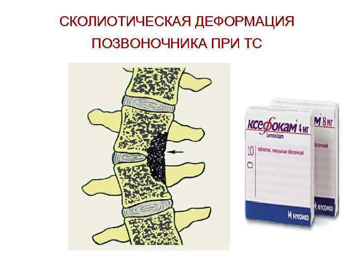 СКОЛИОТИЧЕСКАЯ ДЕФОРМАЦИЯ ПОЗВОНОЧНИКА ПРИ ТС 