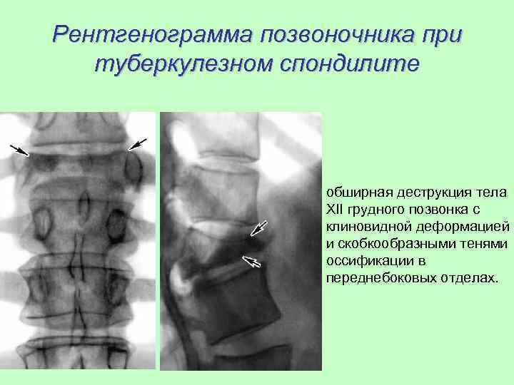 Деформация позвонков. Клиновидная деформация l2 позвонка. Туберкулезный спондилит позвоночника рентген. Клиновидная деформация позвонка рентген. Клиновидная деформация позвонков рентген.