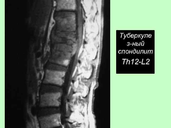  • Th 12 -L 2 Туберкуле з-ный спондилит Th 12 -L 2 