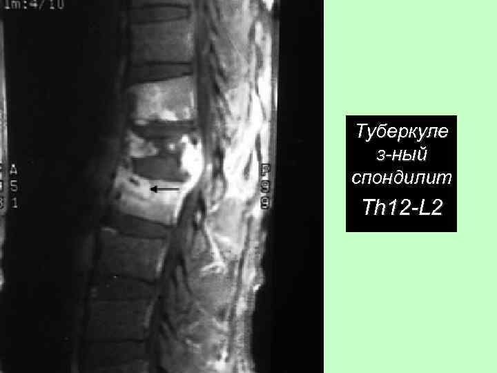 Туберкуле з-ный спондилит Th 12 -L 2 