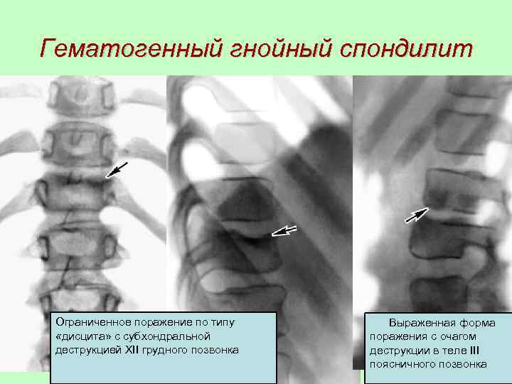 Спондилит