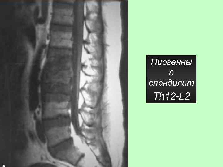 Пиогенны й спондилит Th 12 -L 2 