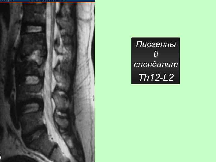 Пиогенны й спондилит Th 12 -L 2 