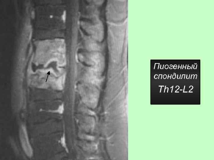 Пиогенный спондилит Th 12 -L 2 