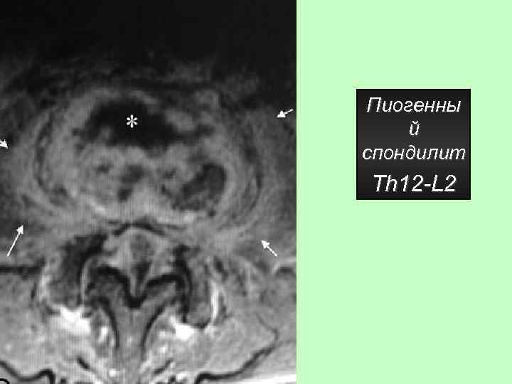 Пиогенны й спондилит Th 12 -L 2 