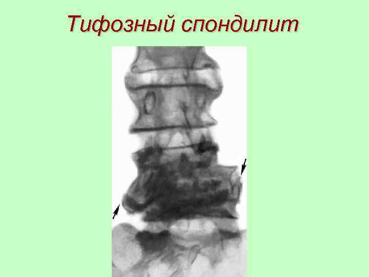 Тифозный спондилит 