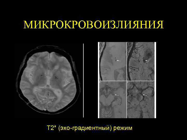 МИКРОКРОВОИЗЛИЯНИЯ Т 2* (эхо-градиентный) режим 