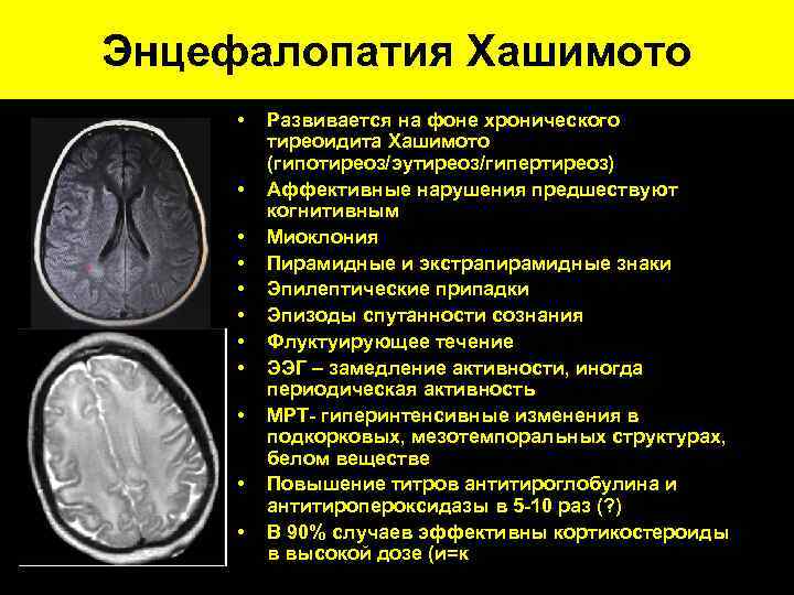 Признаки энцефалопатии мозга. Энцефалопатия Хашимото. Энцефалопатия Хашимото мрт. Энцефалопатия головного мозга на кт.