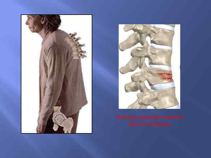 Компрессионный перелом при остеопорозе 
