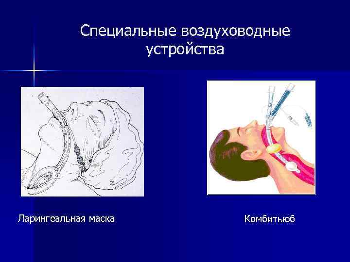 Специальные воздуховодные устройства Ларингеальная маска Комбитьюб 