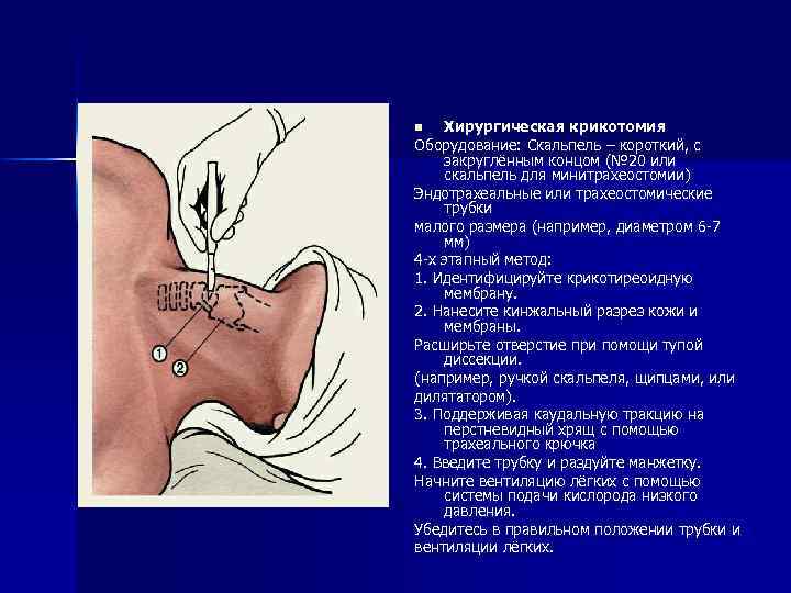 Хирургическая крикотомия Оборудование: Скальпель – короткий, с закруглённым концом (№ 20 или скальпель для