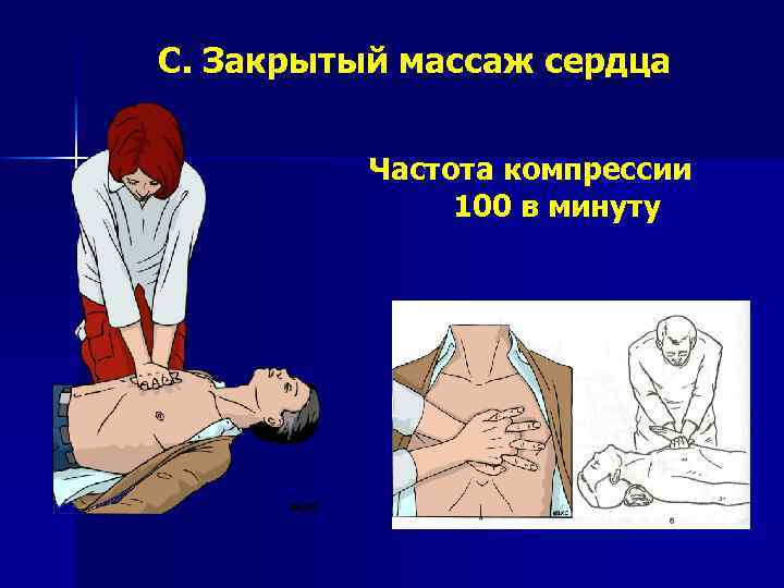 C. Закрытый массаж сердца Частота компрессии 100 в минуту 