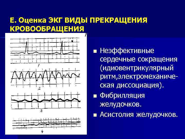 ЭКГ виды. Желудочковая асистолия на ЭКГ. Кардиограмма в виде сердца. Асистолия сердца это