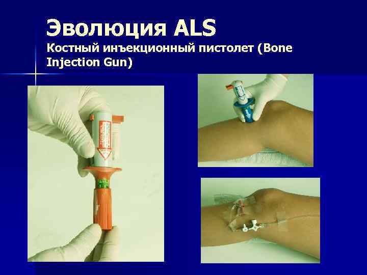 Эволюция ALS Костный инъекционный пистолет (Bone Injection Gun) 
