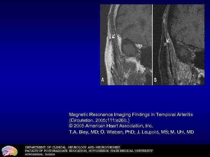 Magnetic Resonance Imaging Findings in Temporal Arteritis (Circulation. 2005; 111: e 260. ) ©