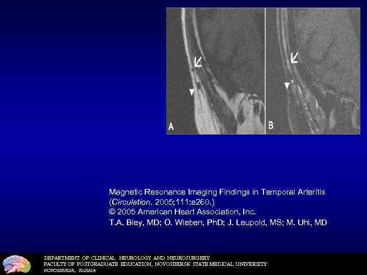 Magnetic Resonance Imaging Findings in Temporal Arteritis (Circulation. 2005; 111: e 260. ) ©