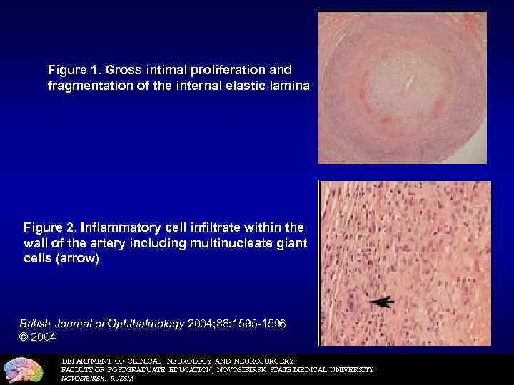 Figure 1. Gross intimal proliferation and fragmentation of the internal elastic lamina Figure 2.