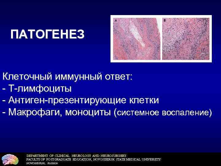 ПАТОГЕНЕЗ Клеточный иммунный ответ: - Т-лимфоциты - Антиген-презентирующие клетки - Макрофаги, моноциты (системное воспаление)