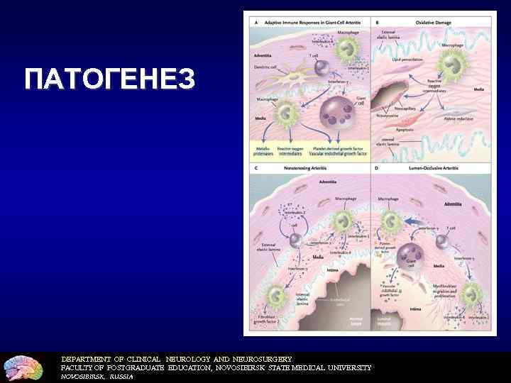 ПАТОГЕНЕЗ DEPARTMENT OF CLINICAL NEUROLOGY AND NEUROSURGERY FACULTY OF POSTGRADUATE EDUCATION, NOVOSIBIRSK STATE MEDICAL