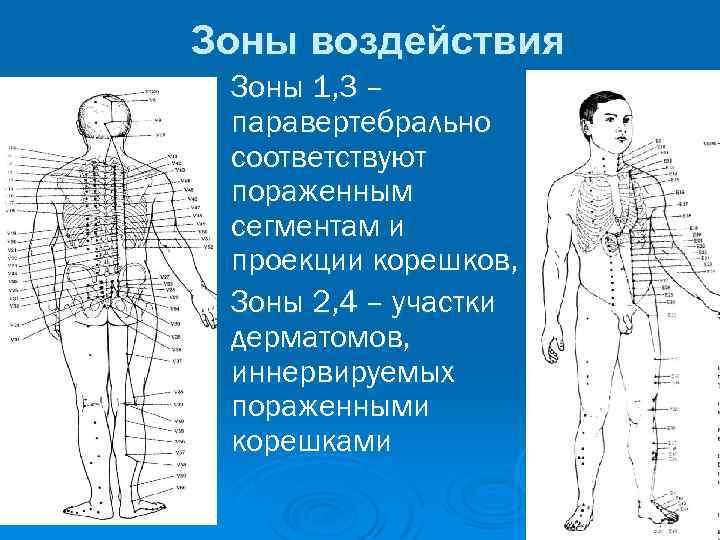 Зоны воздействия Зоны 1, 3 – паравертебрально соответствуют пораженным сегментам и проекции корешков, Зоны