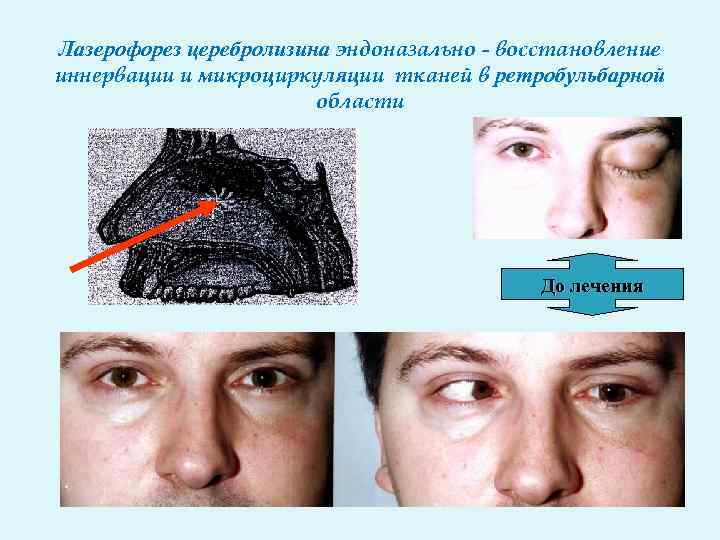 Лазерофорез церебролизина эндоназально - восстановление иннервации и микроциркуляции тканей в ретробульбарной области До лечения