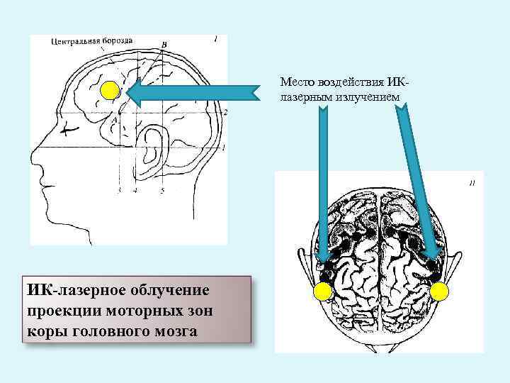 Место воздействия ИК лазерным излучением ИК-лазерное облучение проекции моторных зон коры головного мозга 