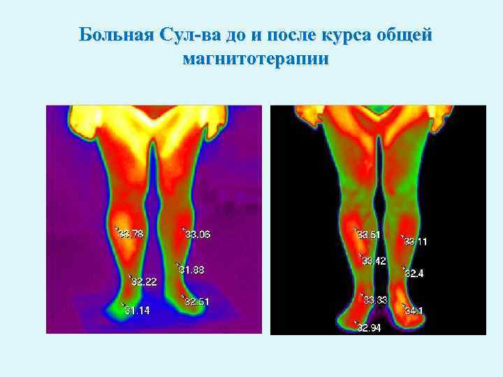 Больная Сул-ва до и после курса общей магнитотерапии 