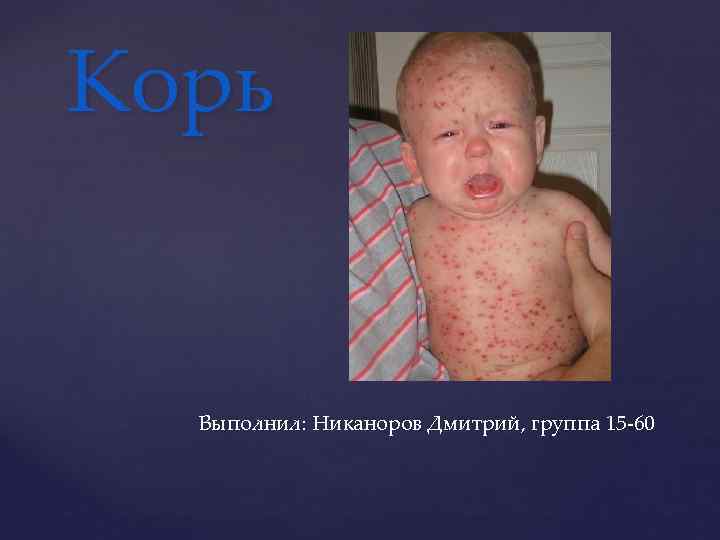 Корь Выполнил: Никаноров Дмитрий, группа 15 -60 