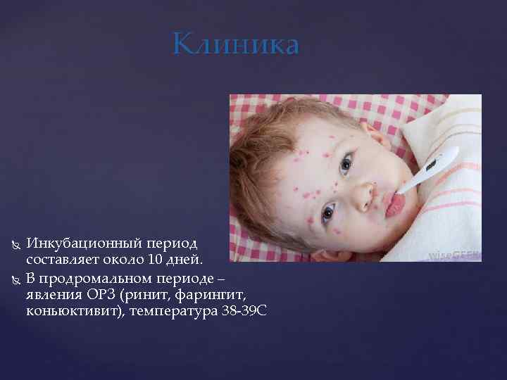  Клиника Инкубационный период составляет около 10 дней. В продромальном периоде – явления ОРЗ