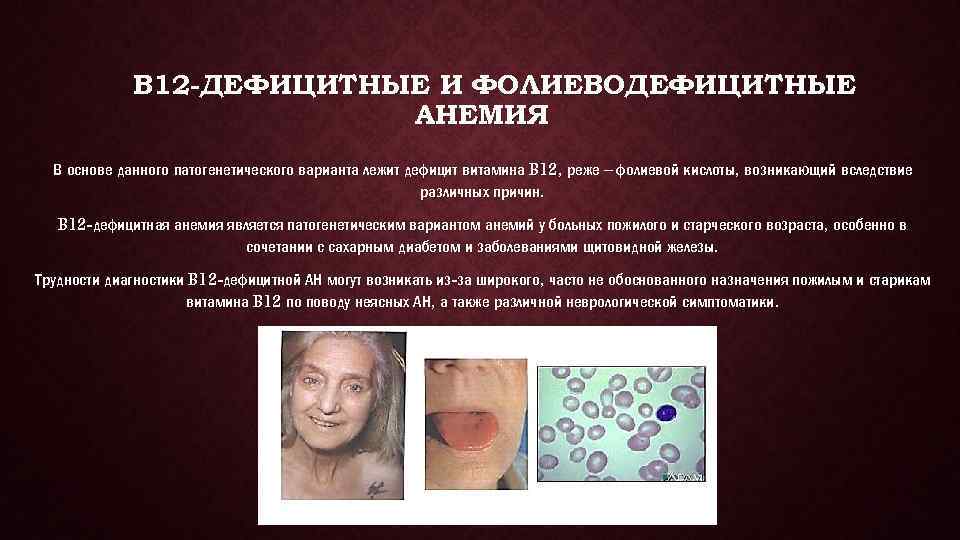 B 12 -ДЕФИЦИТНЫЕ И ФОЛИЕВОДЕФИЦИТНЫЕ АНЕМИЯ В основе данного патогенетического варианта лежит дефицит витамина