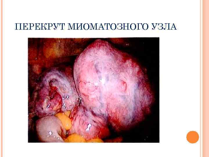 ПЕРЕКРУТ МИОМАТОЗНОГО УЗЛА 