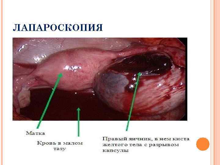 ЛАПАРОСКОПИЯ 