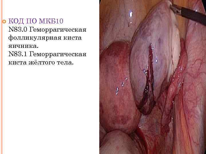  КОД ПО МКБ 10 N 83. 0 Геморрагическая фолликулярная киста яичника. N 83.