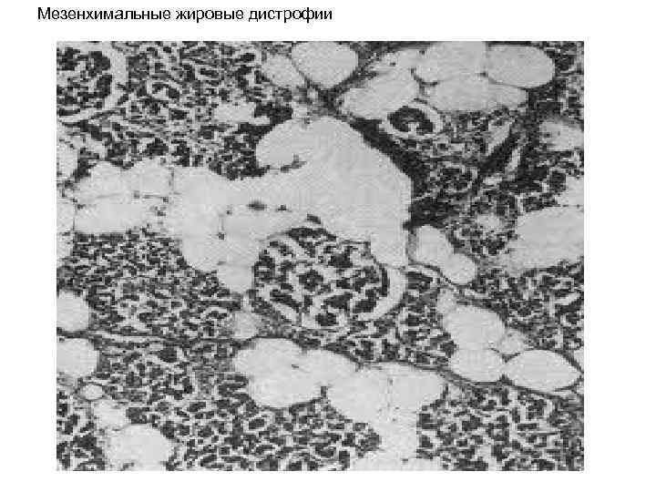 Мезенхимальные жировые дистрофии 